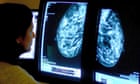 US cancer death rates continue to fall as 5-year survival rates rise - study