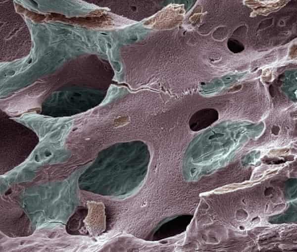 An electron micrograph image of a of human bone with osteoporosis.