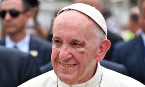 Pope Francis, showing a bruise around his left eye and eyebrow caused by an accidental hit against the popemobile’s window glass.
