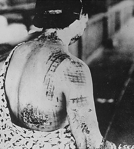 A Japanese woman’s skin burned in a pattern corresponding to the dark portions of a kimono she wore at the time of the atomic bomb explosion in 1945.