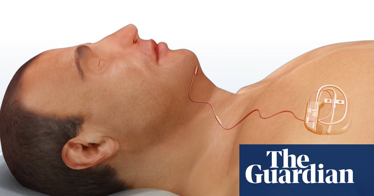 NHS begins treating sleep apnoea with pioneering chest implant
