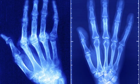 X ray image of arthritis sufferer
