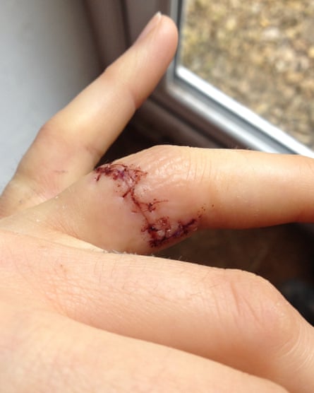 Wedding ring finger with stitches across it.