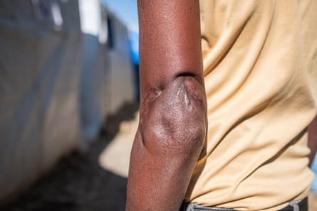 A man’s arm with a deep scar above the elbow.