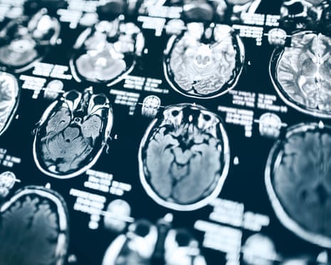MRI scan of a brain