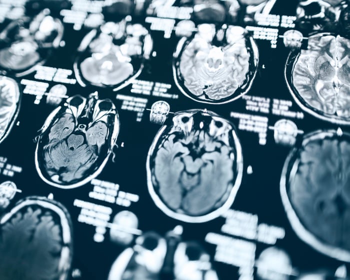Trump funding cuts may force Alzheimer’s disease study to shut down, affecting 600 aging adults