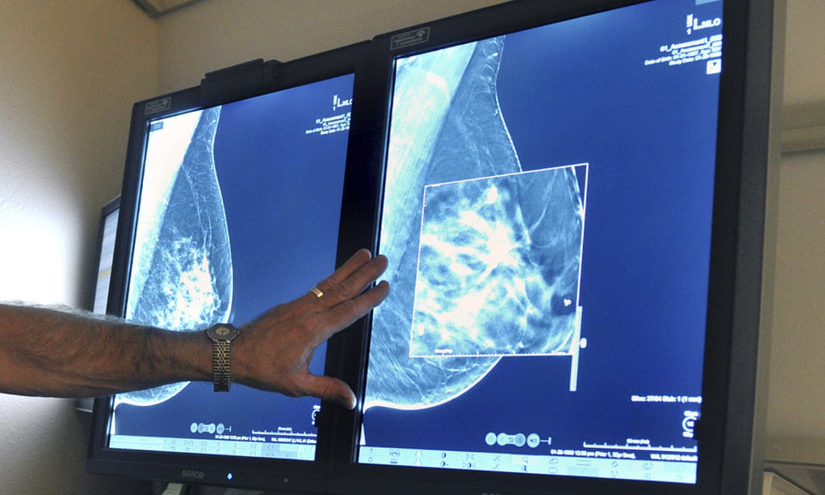 More detailed MRI to detect early breast cancer begins UK trials | Breast  cancer | The Guardian