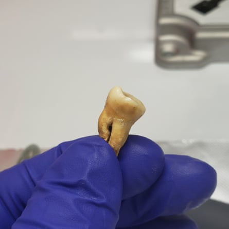 a tooth in a person’s hand