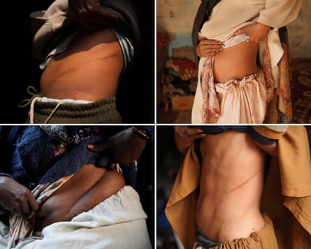 Montage of four photos of people with scars on their torsos