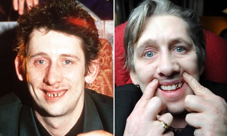 Shane MacGowan before and after having twenty-two new teeth