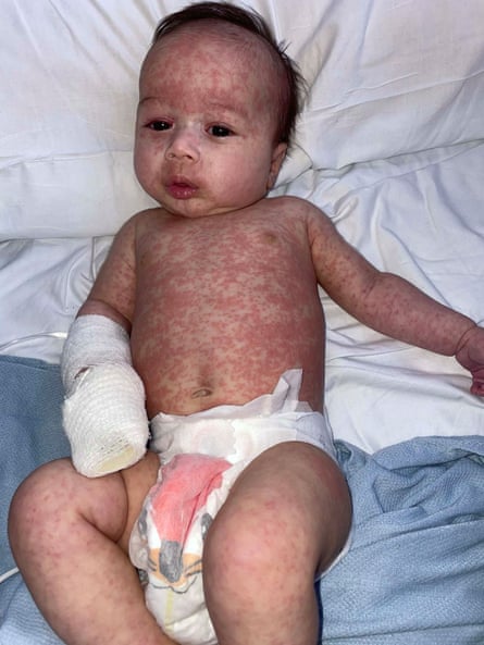 A baby with a severe measles rash.