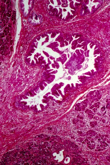 Pancreatic cancer. Light micrograph of a section from a malignant pancreatic adenocarcinoma. This is a cancerous tumour in the ducts (white) of the pancreas that carry digestive juices to the small intestine. Treatment is by chemotherapy and surgical removal of the tumour. Prognosis is poor, as symptoms rarely occur until the cancer is advanced, by which point it may have metastasised (spread) to other organs.