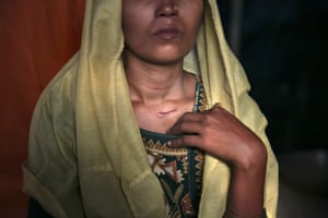 Roshida Begum, 22, shows a scar that she says was left by the Myanmar military after they raped her and attempted to slit her throat