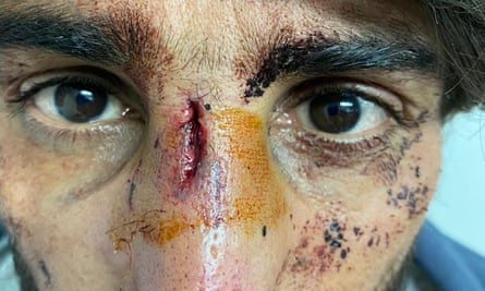 A man shows face wounds he says were inflicted by Croatian police.