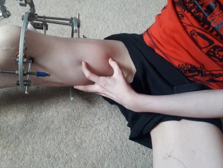 James’s leg in a frame