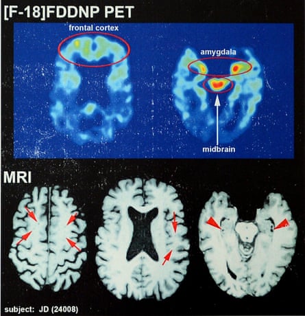 The 2014 brain scans of Joe DeLamielleure, one of the first living NFL players to be tested and diagnosed with CTE.