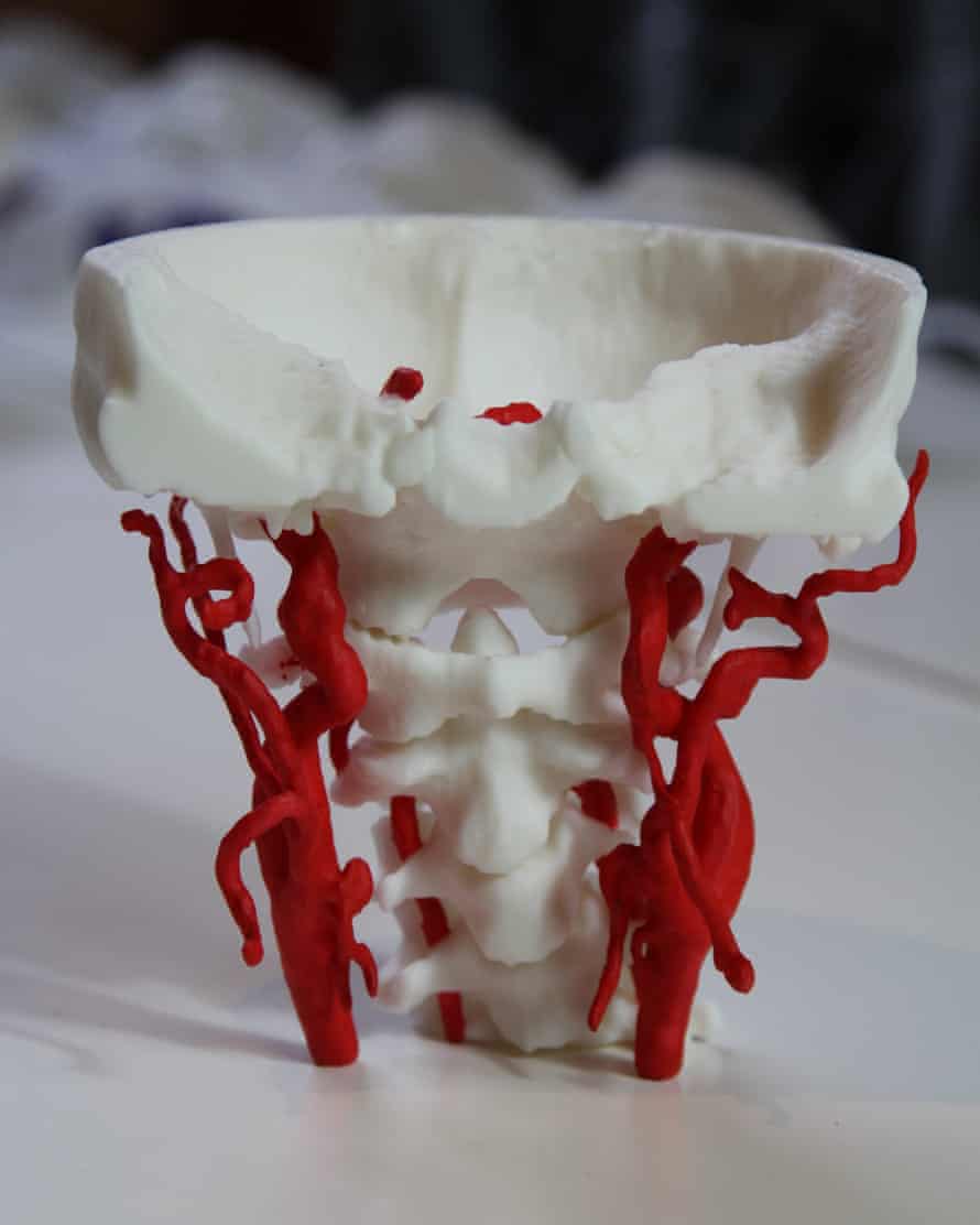 A model of an aneurism model created by Axial3D
