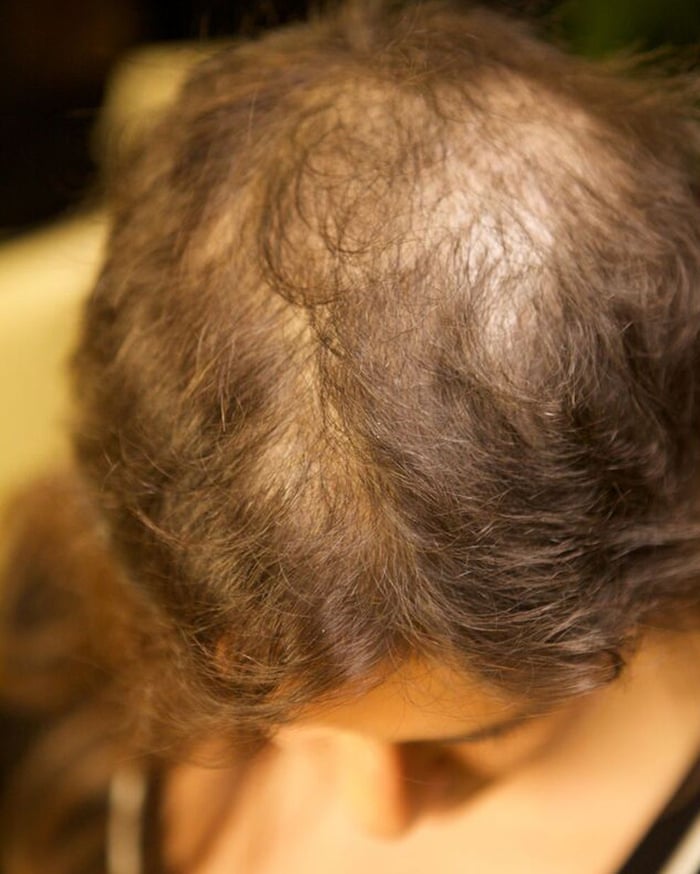 Tearing Our Hair Out Learning To Treat Compulsive Hair