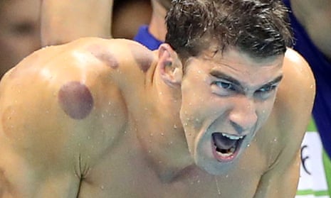 Marks caused by suction cups visible on Michael Phelps as he swims