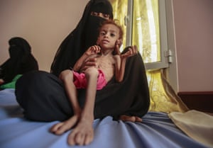 A woman holds a malnourished boy at the Aslam Health Center, in Hajjah, Yemen, 1 October 2018. 1.8 million children in the country are severely malnourished