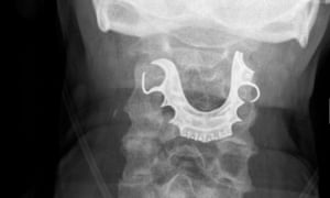 X-ray of false teeth lodged in man's larynx.