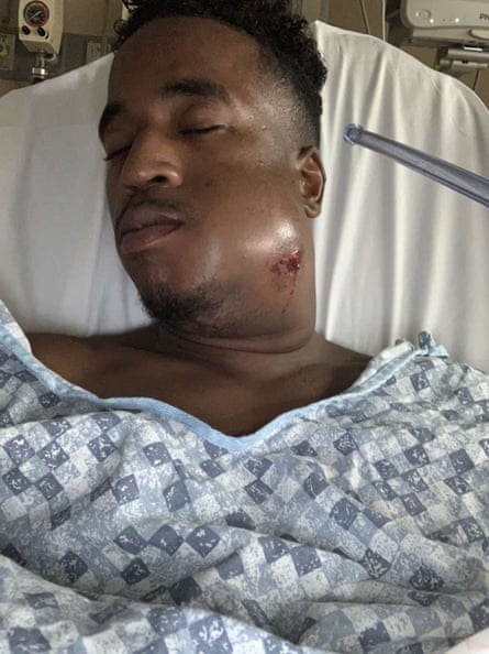 Anthony Evans said he was shot in the jaw by a less-than-lethal round as he took part in a Black Lives Matter protest in Austin.