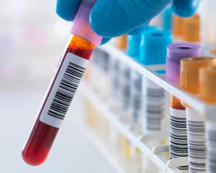 Scientists develop first ‘accurate blood test’ to detect chronic fatigue syndrome