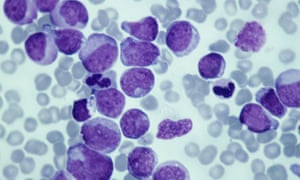 A third of cancer cases involving children under the age of 15 related to leukaemia, the study found. 