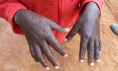 A young boy holds out hands affected by scabies, an infectious disease caused by tiny mites burrowing into the skin.