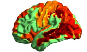 Researchers measured the activity of neurons in people’s brains as the drugs took hold.