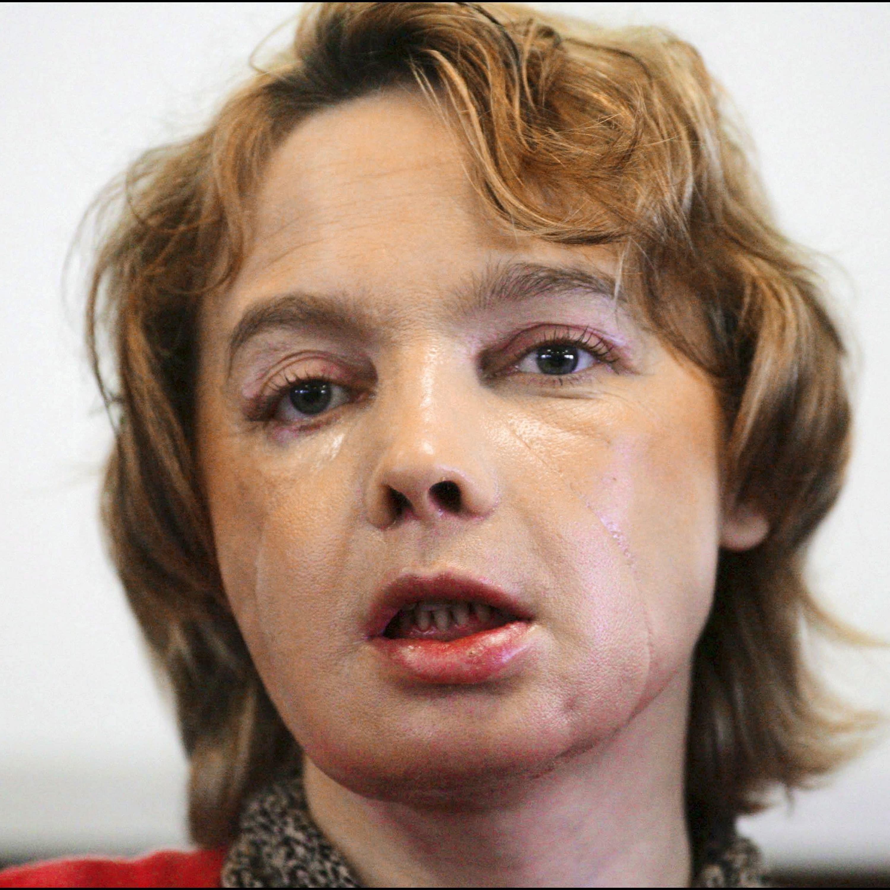 The ‘guinea pigs’ who had face transplant surgery