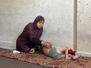 A mother tends to the back of six-and-a-half-year-old Nur Huda al-Hajjaj