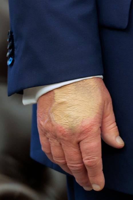 Donald Trump’s hand was partially covered in makeup last Friday in the Oval Office.