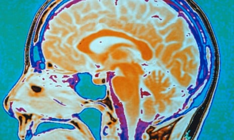 An image of the brain captured by a PET scanner.