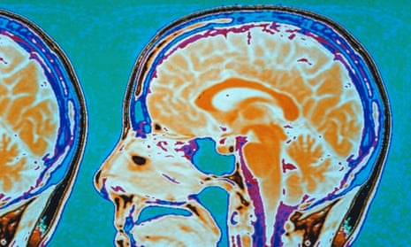 A brain scan, using positron emission tomography. 