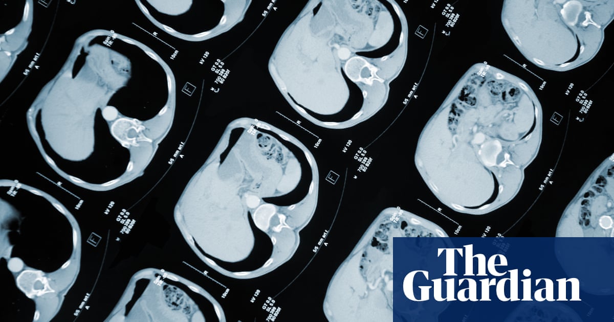 Australia high cancer survival rates attributed to earlier detection