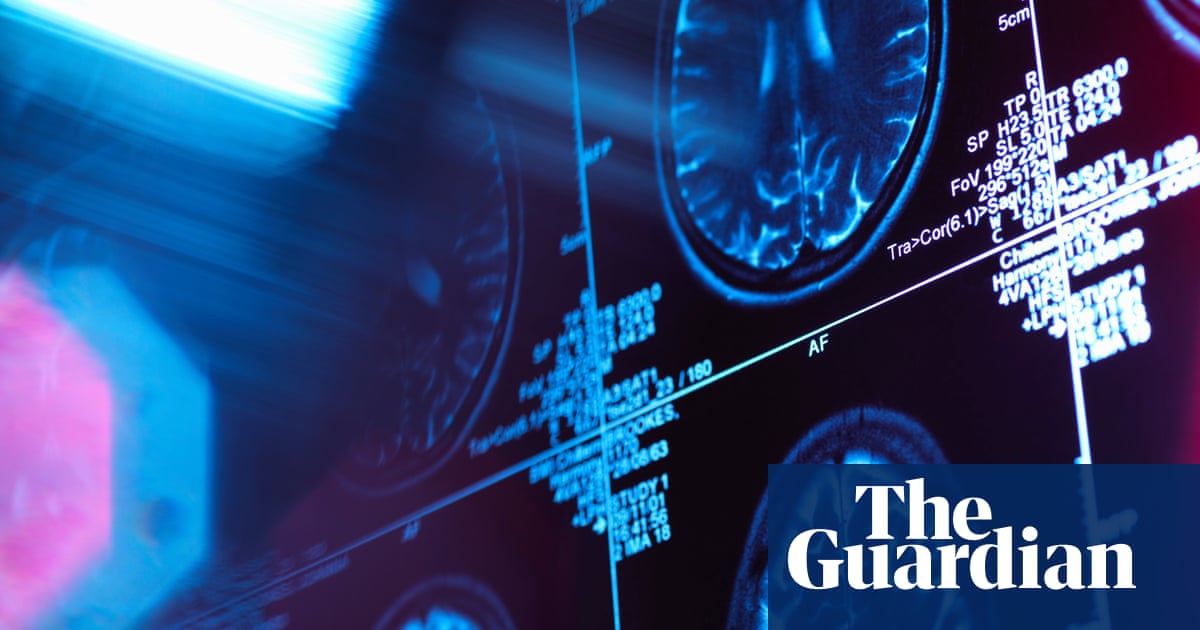 Study links greater inequality to structural changes in children's brains