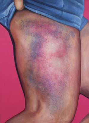 Wait Long Enough and Someone Will Find a Picture of Jesus in That Bruise!, 2014