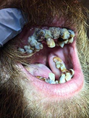 A patient who came into the clinic needing all 30 of his teeth to have root canal surgery.