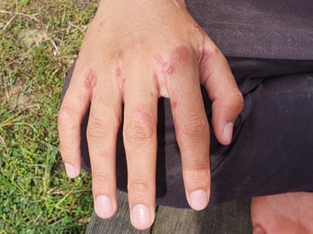 Scabies bumps on a hand between the fingers.