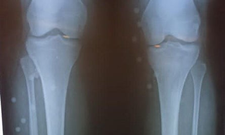 An X-ray image provided by an Iranian doctor of legs showing pellets from a shotgun round.