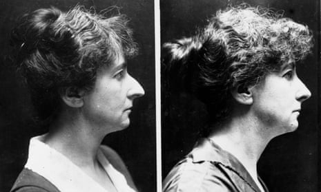 Before and after nose job picture, 1924