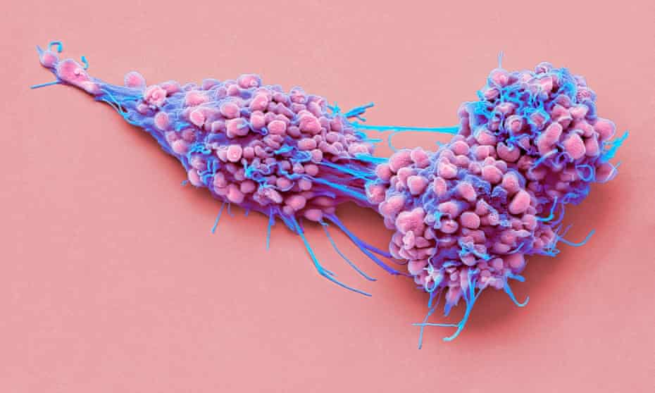 Coloured scanning electron micrograph (SEM) of ovarian cancer cells. 