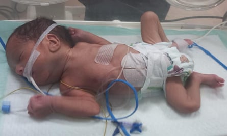 Tiny baby in an incubator with tubes etc.