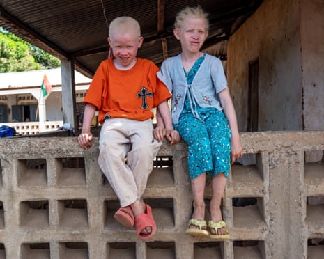 Two children with albinism sitting on a wall