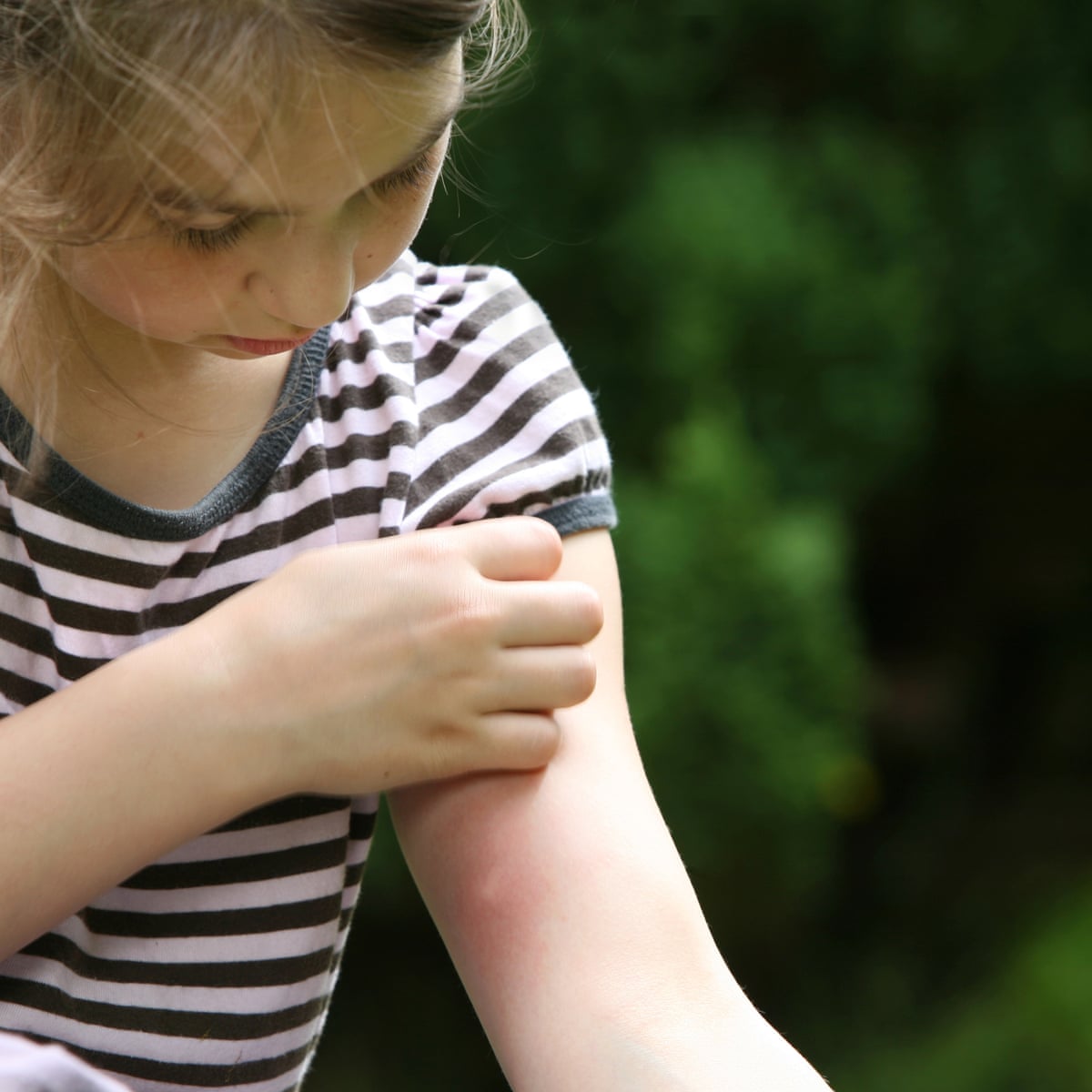 10 Home Remedies For Mosquito Bite Itch 55 OFF 10-home-remedies-for-mosquito-bite-itch-55-off