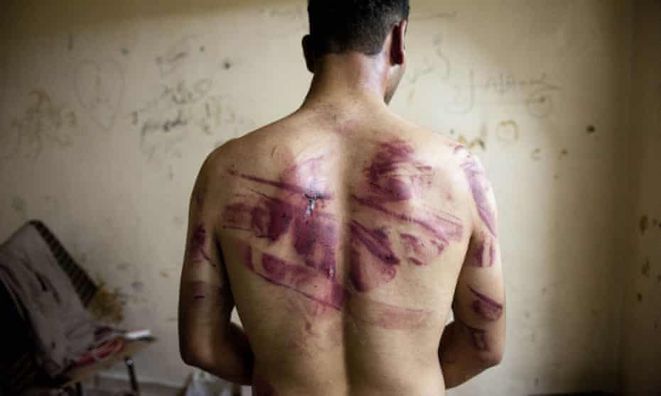 A Syrian man shows marks of torture on his back after his release by Assad forces in 2012