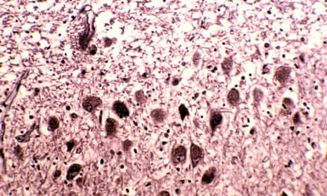 Alzheimer’s disease in the cerebellum of a human brain.