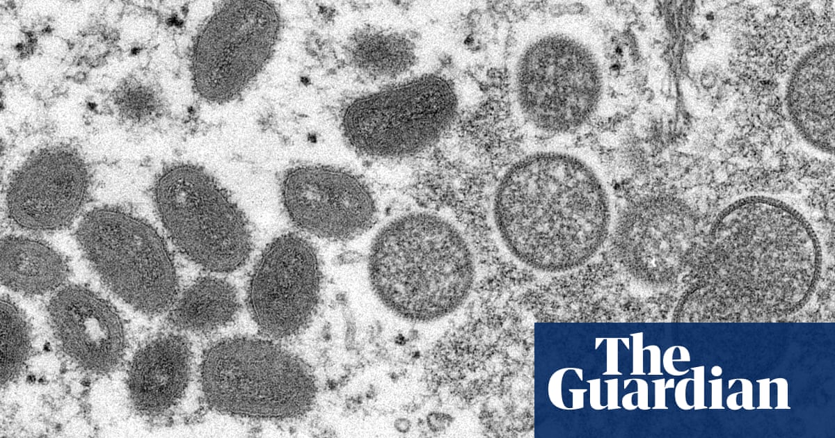 Scotland reports first monkeypox case