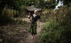 A Malawian woman with albinism in rural Nkole, Machinga district, April 2015